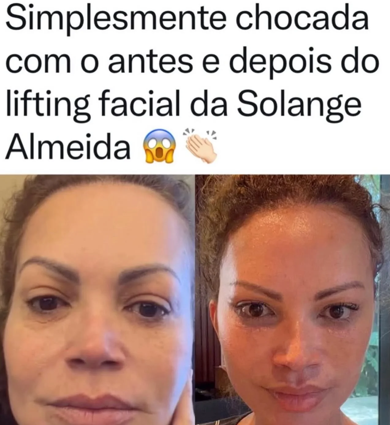 SURPREENDEU! A cantora Solange Almeida, de 51 anos, chamou atenção nas redes sociais ao mostrar o resultado do seu lifting facial. O procedimento, feito há cerca de 15 dias, teve como objetivo rejuvenescer a aparência....