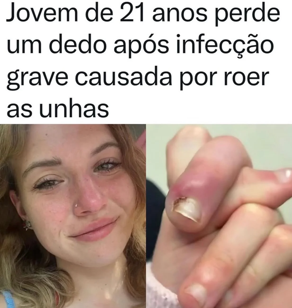 Uma jovem de 21 anos passou por momentos de tensão após desenvolver uma infecção grave em um dos dedos, possivelmente relacionada ao hábito de roer as unhas desde a infância. O que começou como uma simples irritação evo...